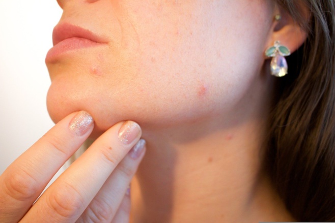 Éclat du teint: bien choisir son acide exfoliant.